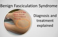 Benign Fasciculation Syndrome Causes and Treatment