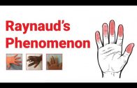 Raynaud’s Phenomenon : What You Should Know | Johns Hopkins Medicine