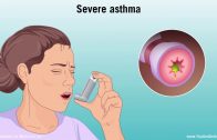 Understanding Asthma: Mild, Moderate, and Severe