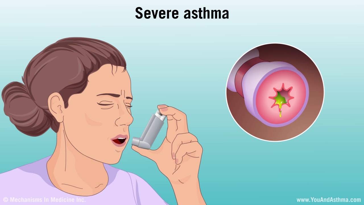 Understanding Asthma Mild, Moderate, and Severe Intratherapies